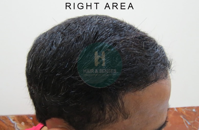 Hairline Designing